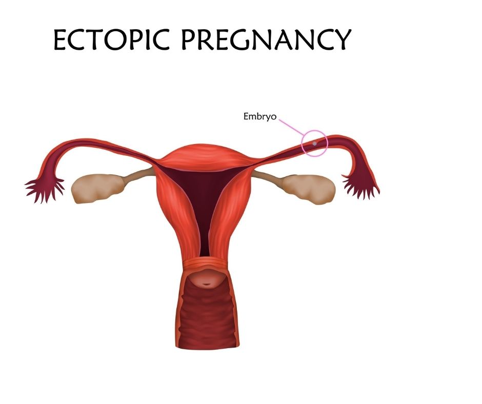 ectopic pregnancy development
