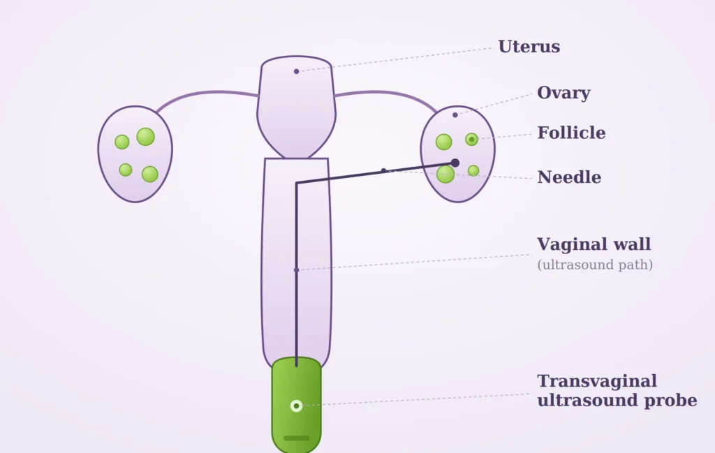 Egg retrieval anatomy diagram
