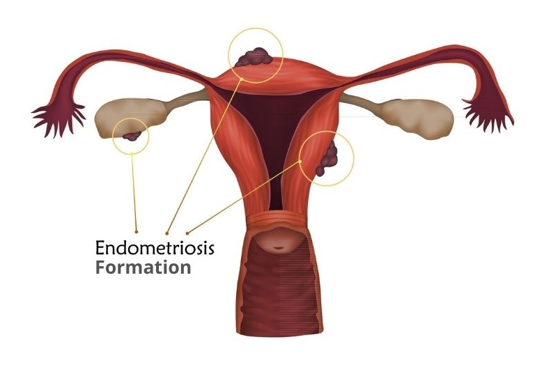 endometriosis formation