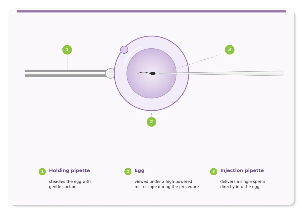 Diagram of the ICSI procedure: a holding pipette steadies the egg while an injection pipette delivers a single sperm directly into it, viewed under a microscope.